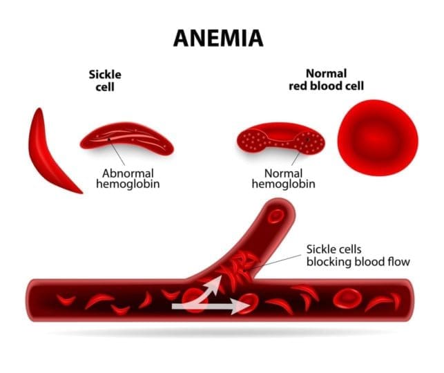 Illustration of normal red blood cells and sickle cells