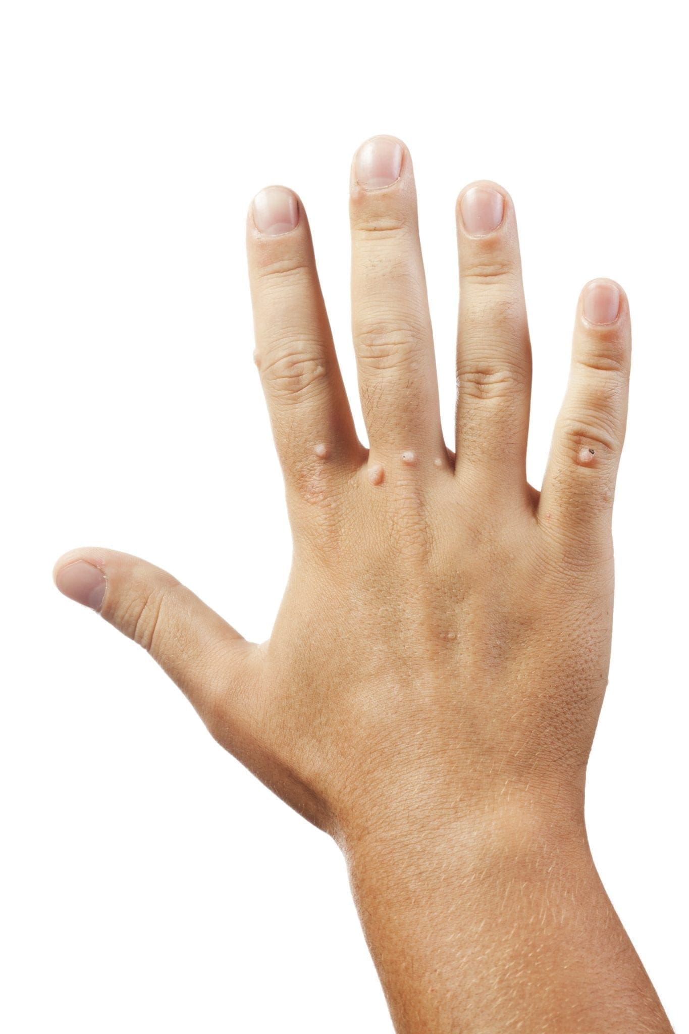 wart virus on fingers