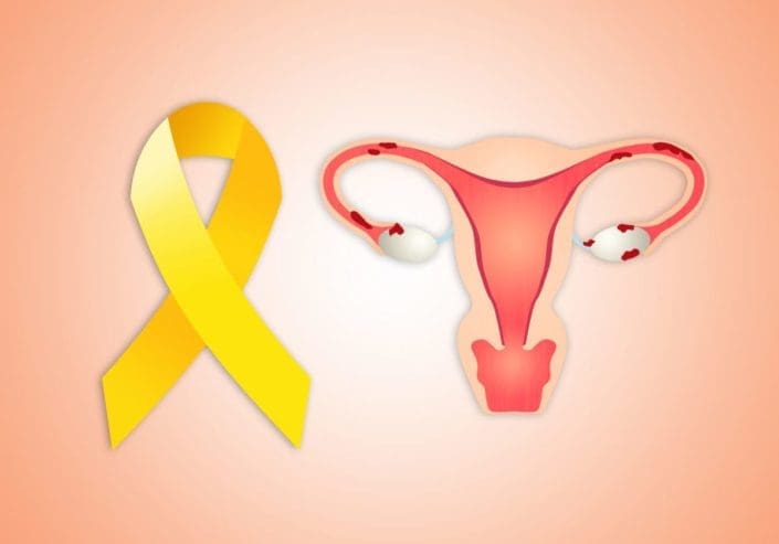 Illustration of the female reproduction system and a yellow ribbon representing endometriosis