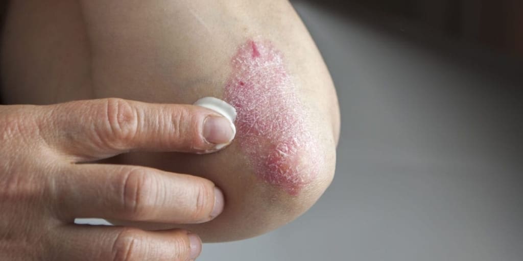 Woman applying lotion to psoriasis on her elbow