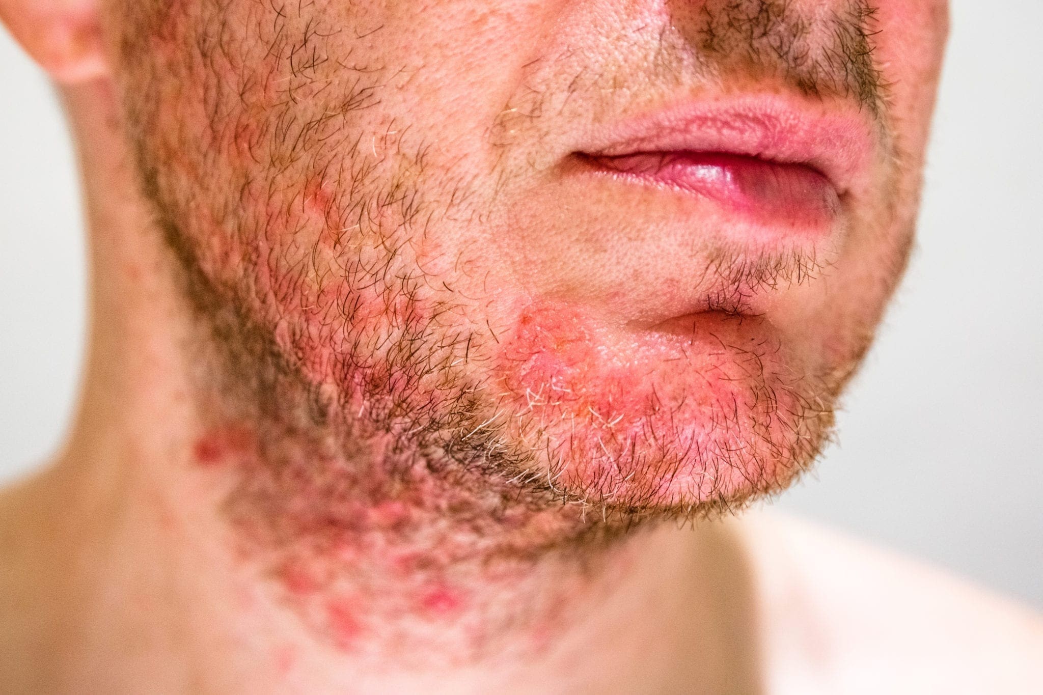 Seborrheic Dermatitis Treatment And Causes 