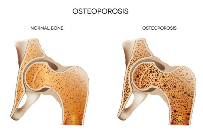 Medical illustration of normal, healthy bone and unhealthy bone with osteoporosis