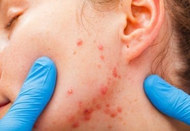 Red bumps may be inflammatory skin condition Hidradenitis suppurative