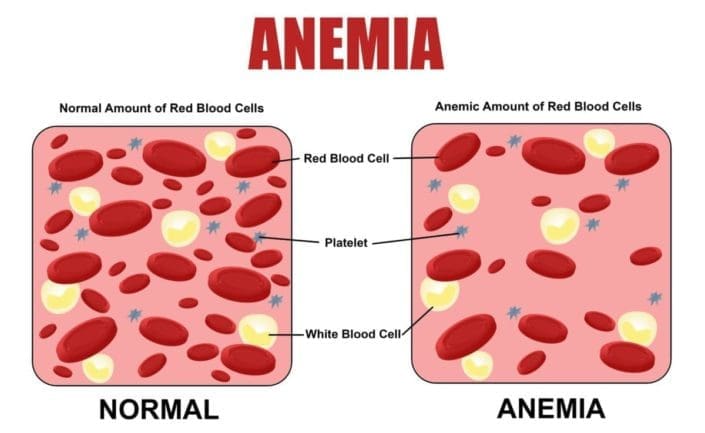 Illustrative comparison of normal amount of red blood cells and anemic amount of red blood cells