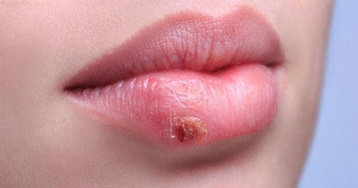 A picture of lips showing a cold sore caused by herpes