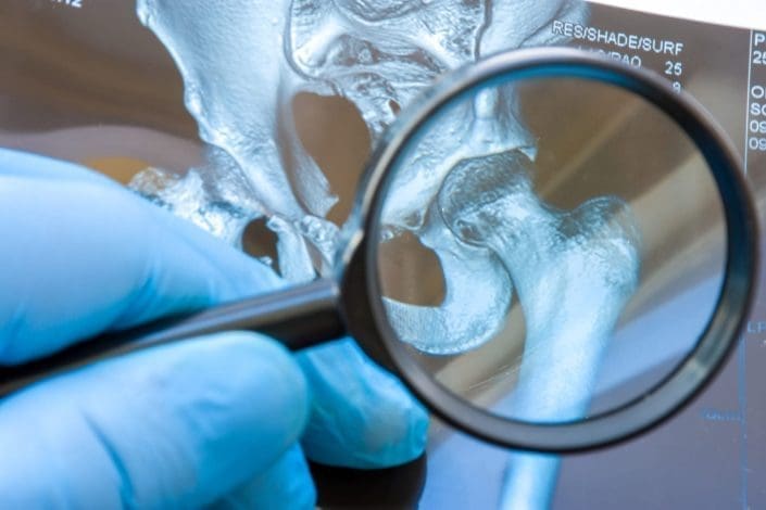 A gloved hand holds a magnifying glass up to a model of a hip joint. Transient synovitis of the hip, also called toxic synovitis, is an inflammation and swelling of the tissues around the hip joint.
