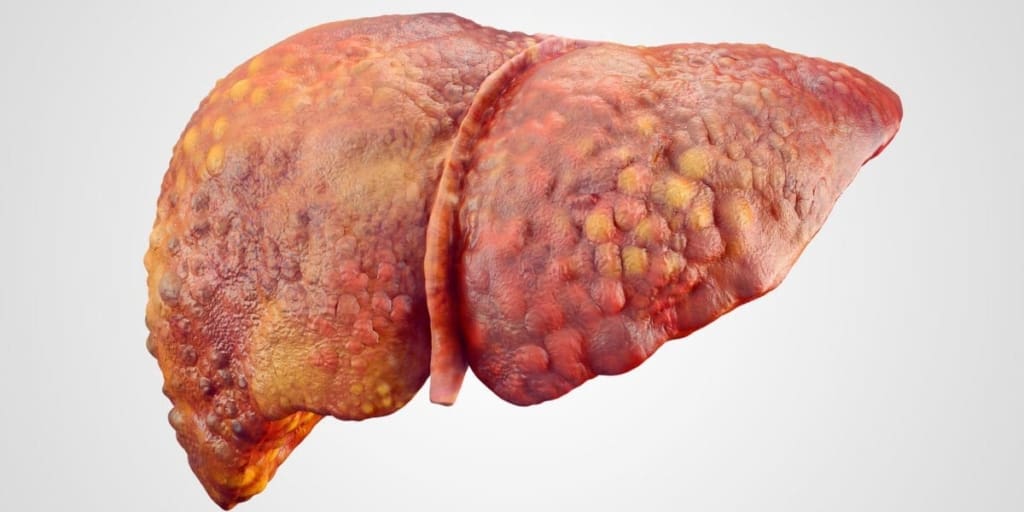 Realistic illustration of cirrhosis of human liver