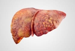 Realistic illustration of cirrhosis of human liver