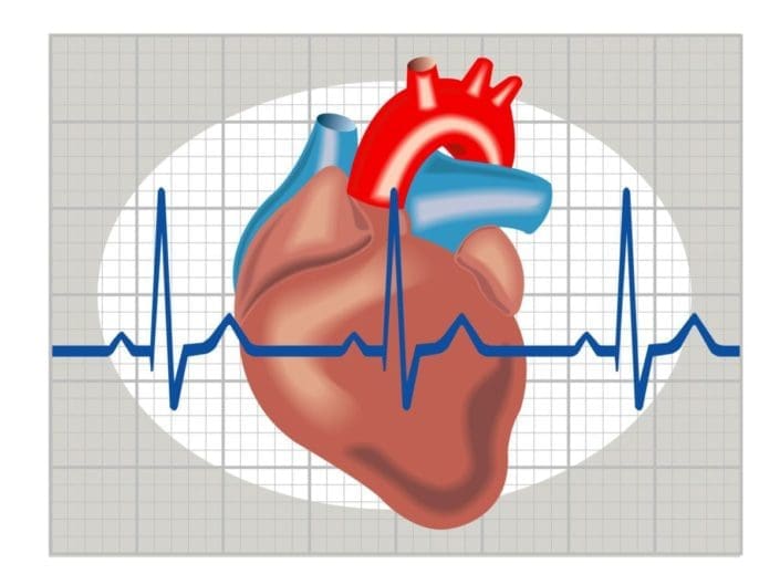 Illustration of cardiac arrhythmia