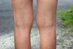 A woman with hives on the backs of her legs