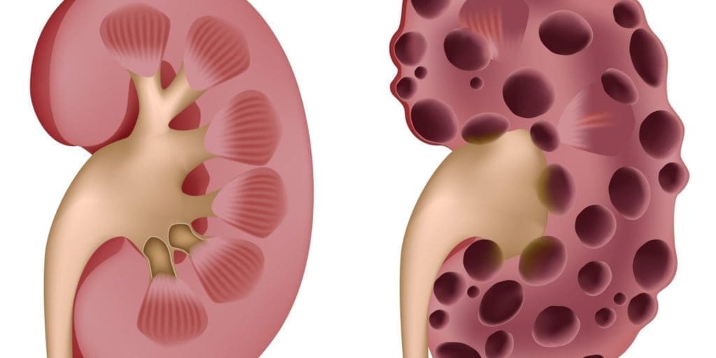 An illustration of a healthy kidney and a kidney with cysts