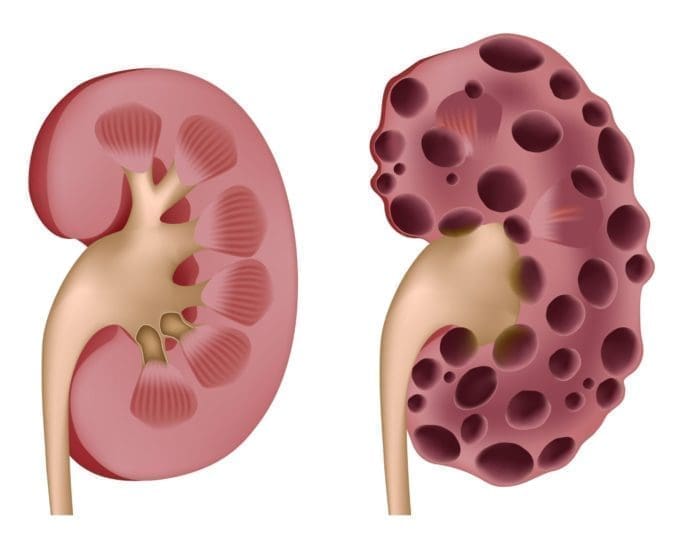 An illustration of a healthy kidney and a kidney with cysts