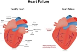 side-by-side diagrams of a healthy heart and one with heart failure