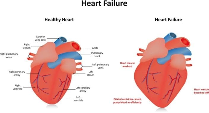 congestive heart failure patient