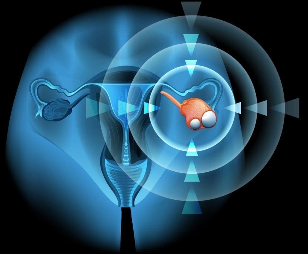 uterus-cyst