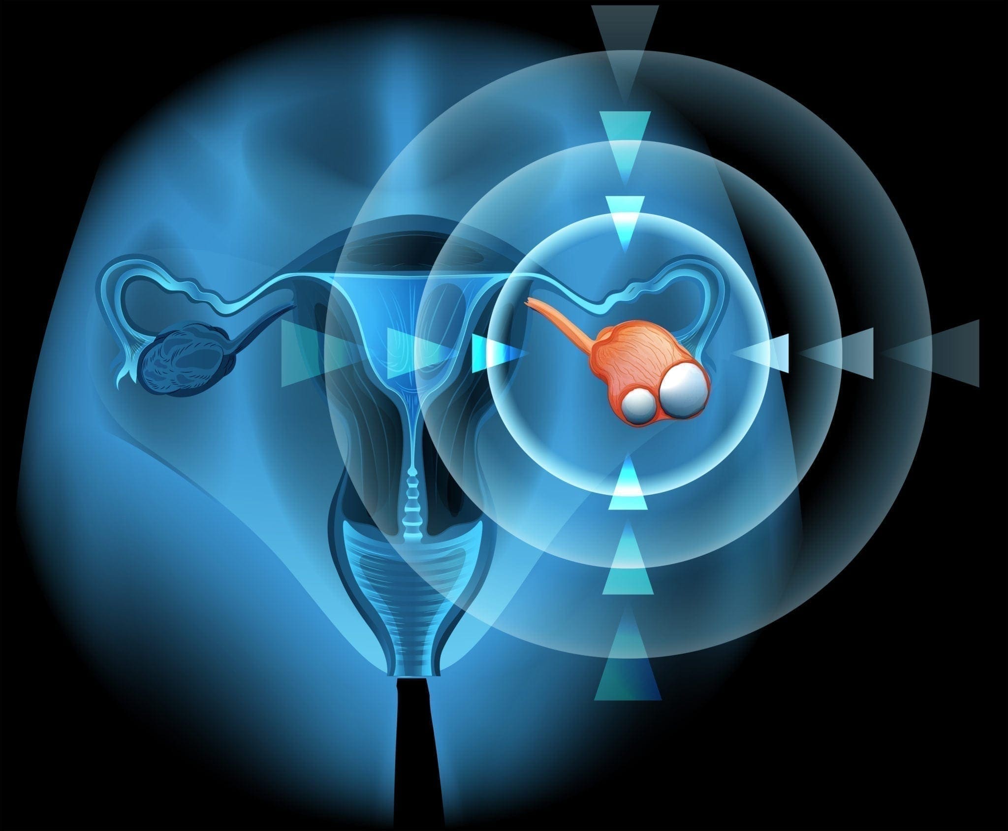 Ovarian Cyst Anatomy