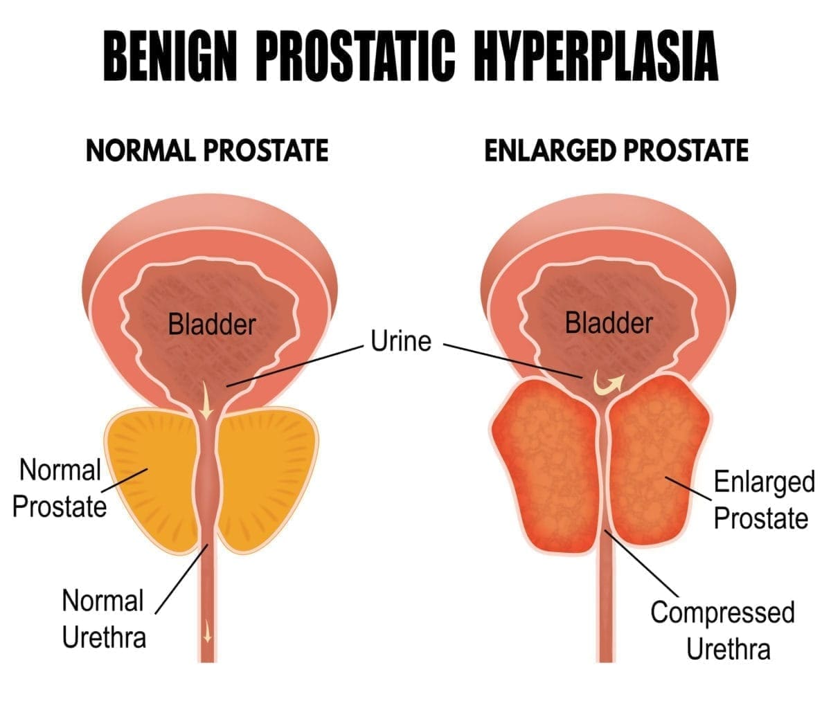 case study 70 benign prostatic hyperplasia