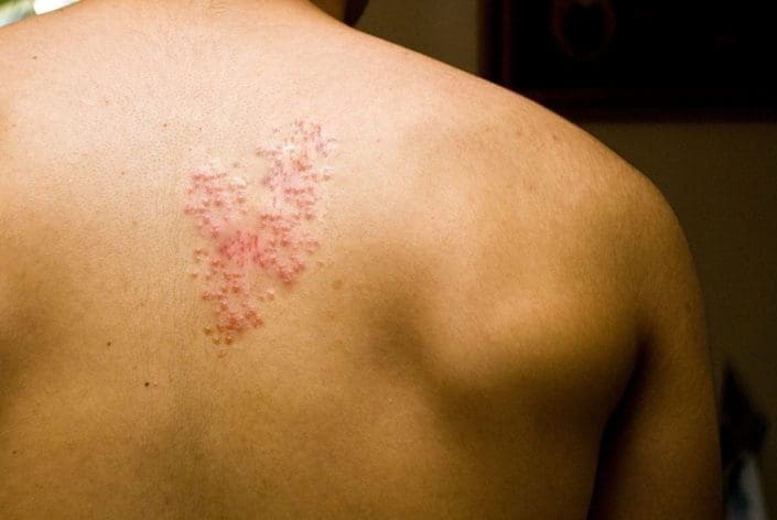 A shingles rash on a man’s back
