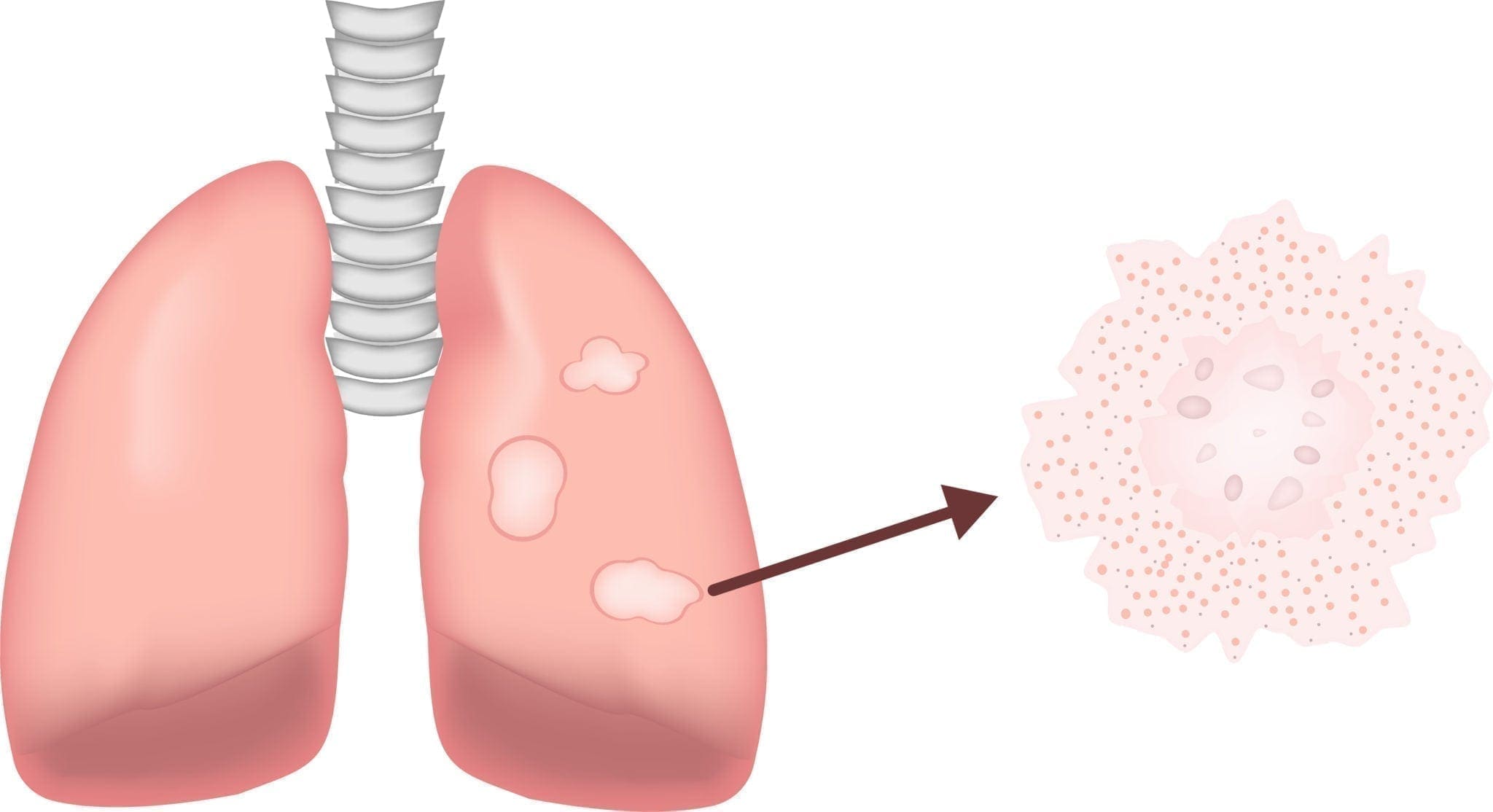 is pleural mesothelioma a lung cancer