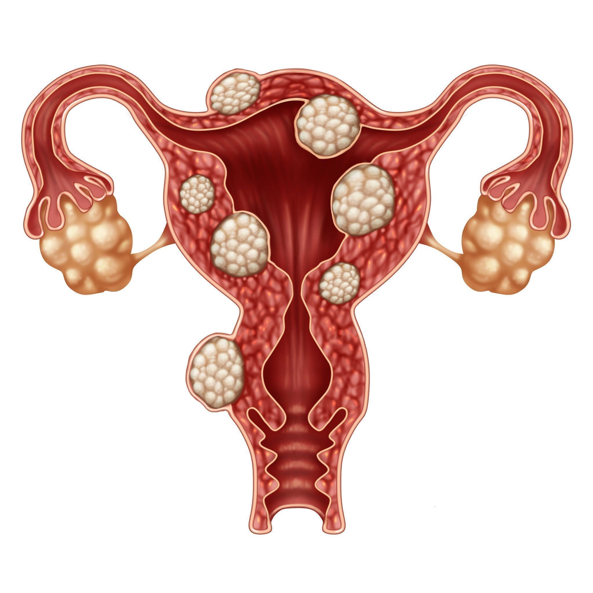 Uterine Fibroids after Menopause