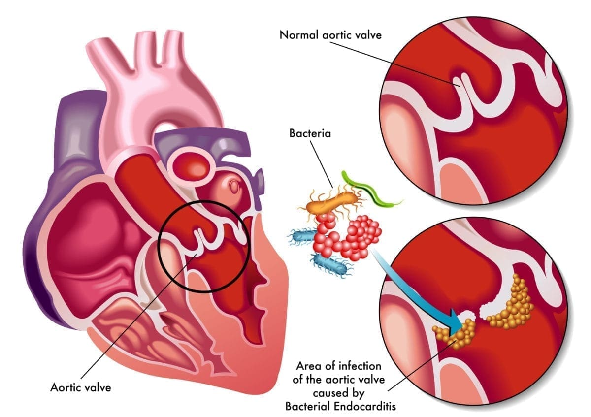 bacterial-endocarditis-familydoctor