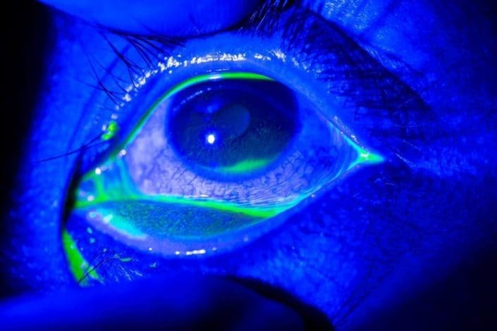 Close-up of corneal abrasion during eye exam in dark room