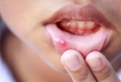 Close-up of child with canker sore on inside of lip
