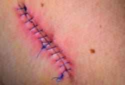 Stitched up wound after surgery.