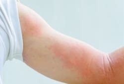 close up image of a man's body suffering severe urticaria nettle rash.