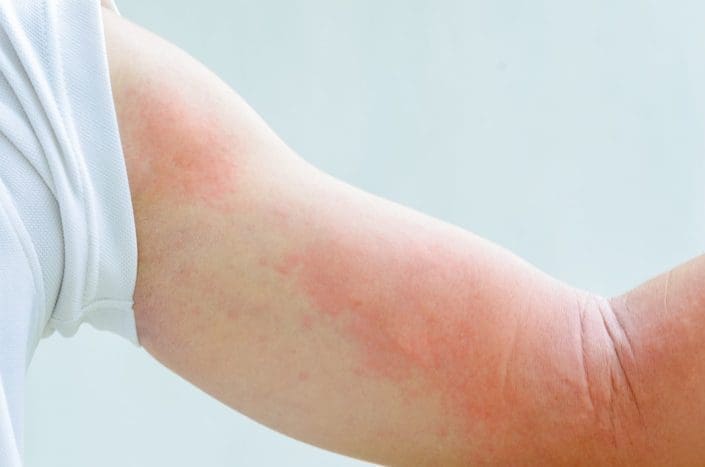 close up image of a man's body suffering severe urticaria nettle rash.