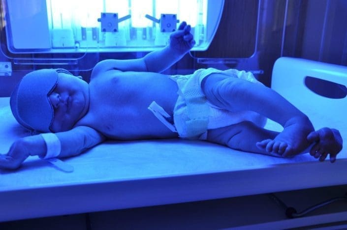 newborn baby with jaundice lies under a special light for treatment