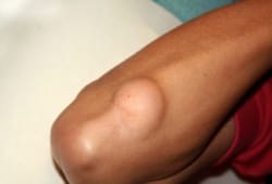 A lipoma under the skin by the elbow. Lipomas are slow-growing tumors that come from fat cells. They are usually round, moveable lumps under the skin.
