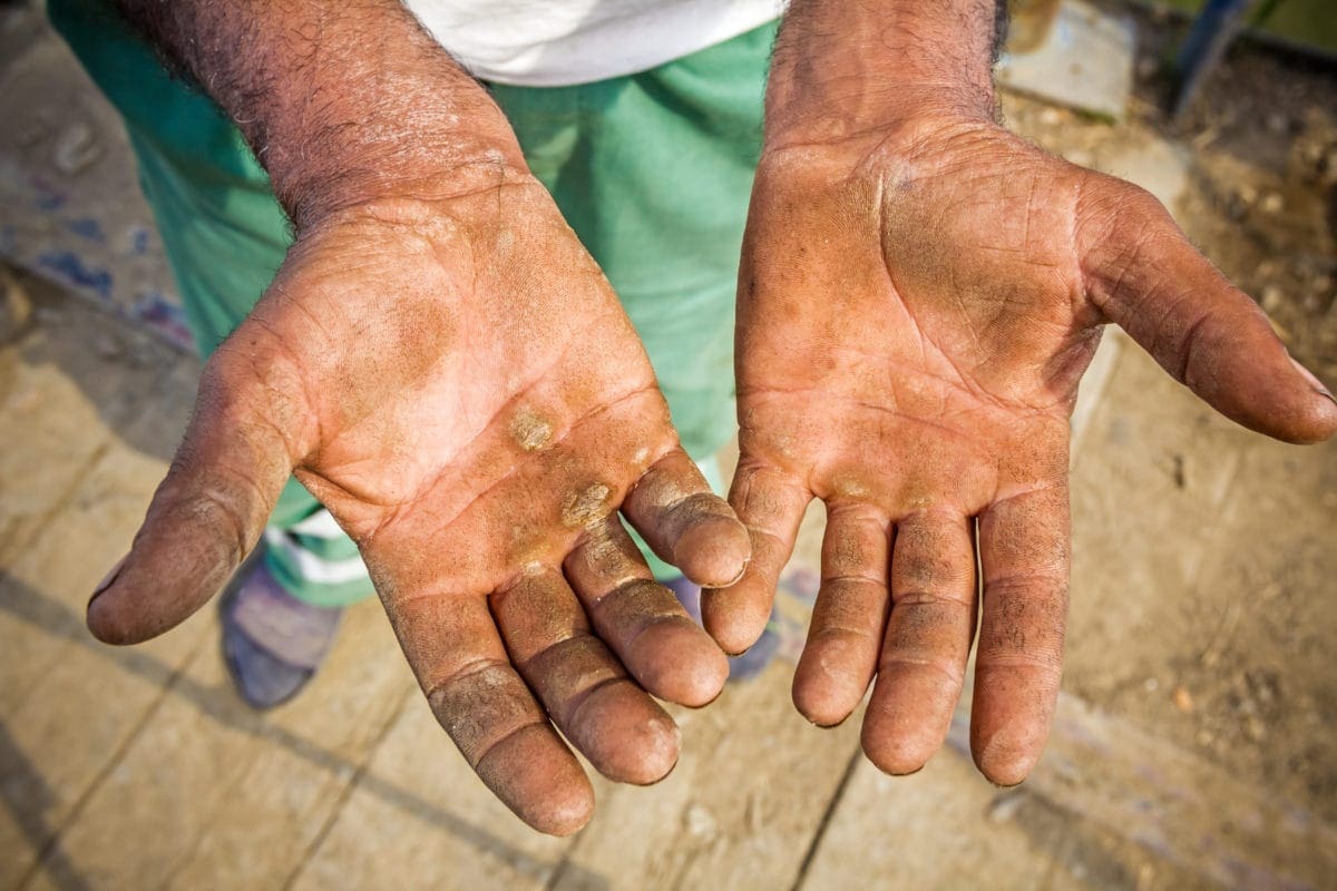 Hand job disease