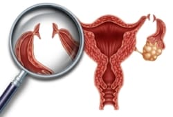 Illustration of a uterus, with focus on incisions on fallopian tubes