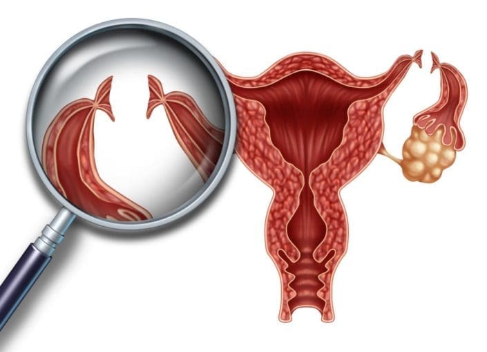 Illustration of a uterus, with focus on incisions on fallopian tubes
