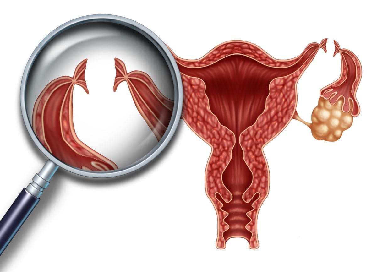 bilateral tubal ligation