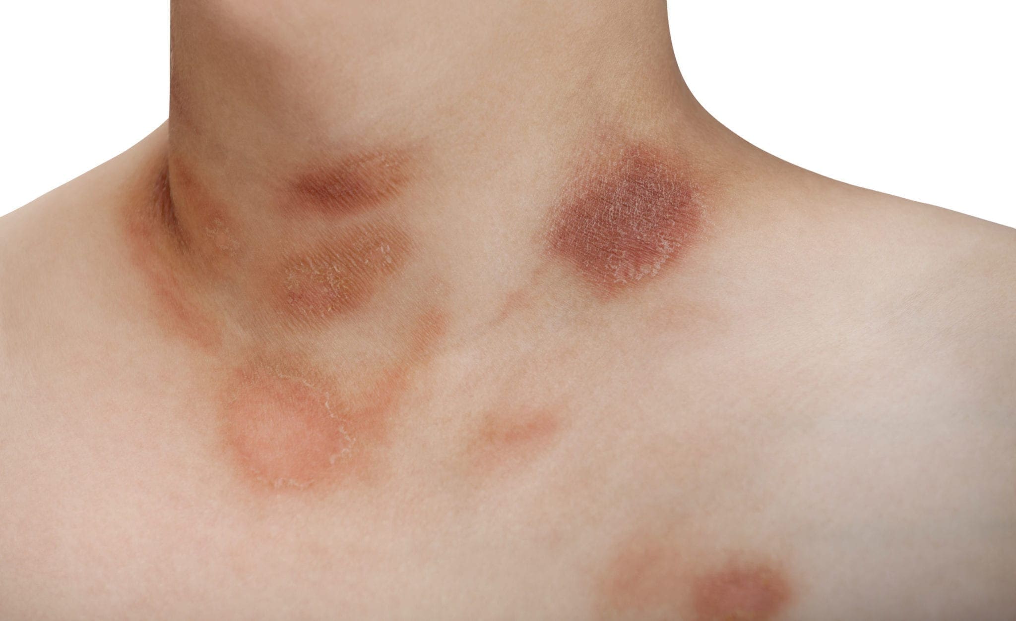 What Is Pityriasis Rosea? - Symptoms and Treatment