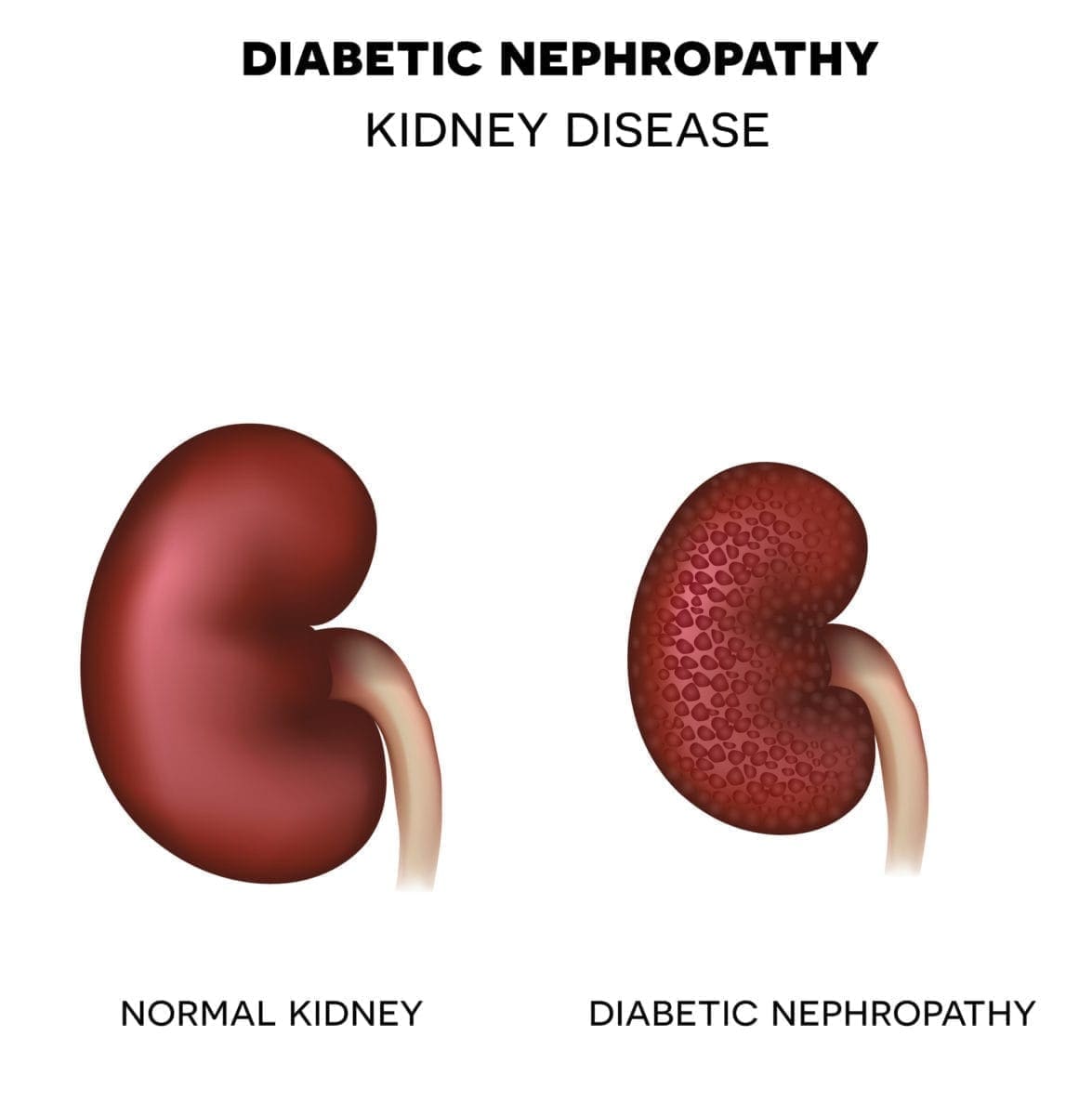 what is diabetic nephropathy)