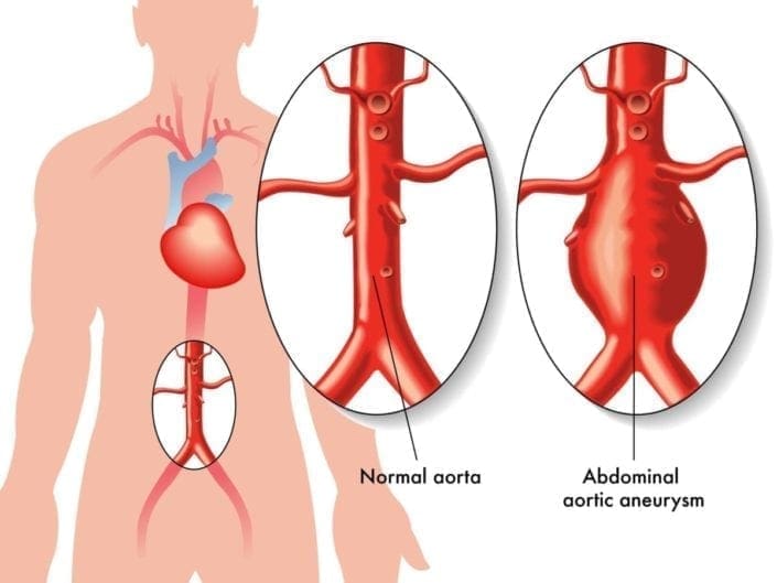 Illustration of a human body with close-ups of a normal aorta and one with an abdominal aortic aneurysm