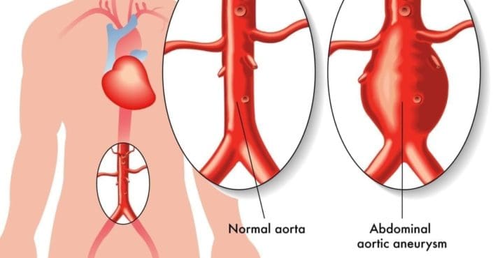 Abdominal Aortic Aneurysm Aaa 5898