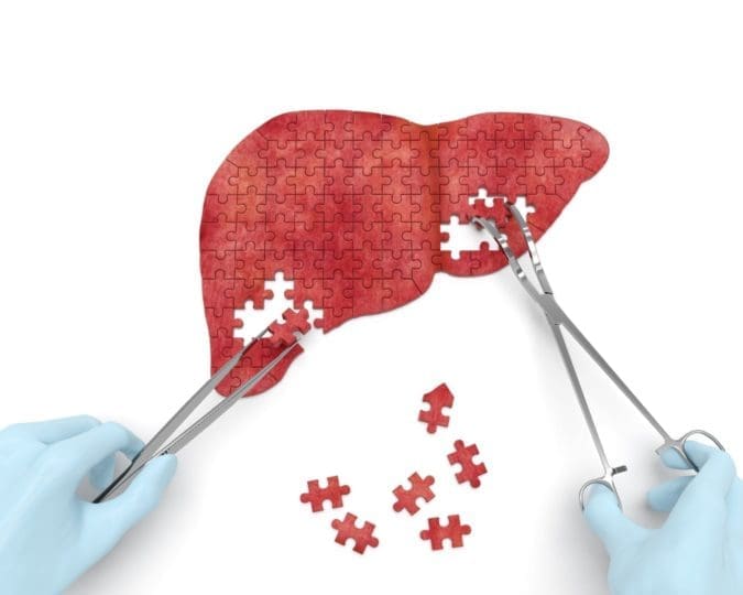 A concept photo of a surgeon putting together a jigsaw puzzle of a liver using surgical instruments.