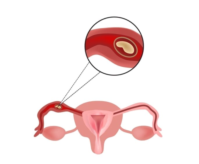 Illustration of female reproductive system with a close-up on an embryo developing in the fallopian tube. An ectopic pregnancy happens when a fertilized egg grows outside the uterus. It can be dangerous to the mother if not treated early enough.