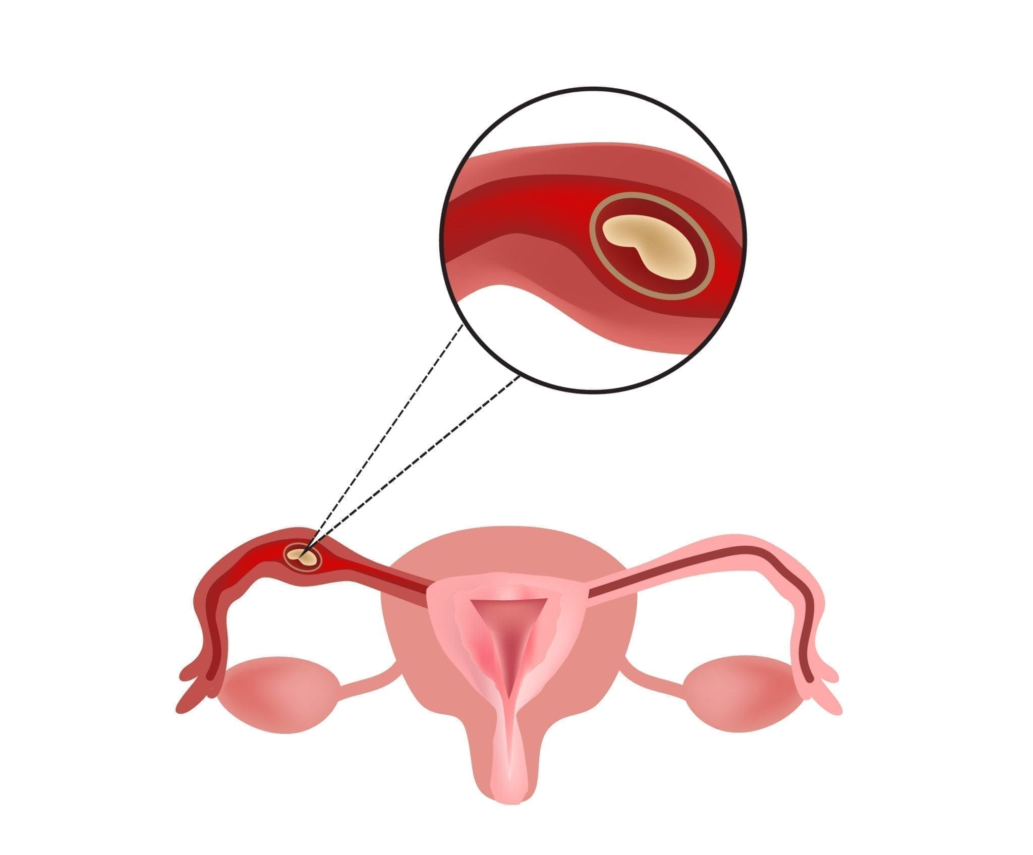 How early can implantation occur after ovulation? - Quora