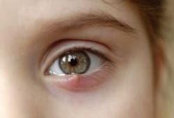 closeup of a sty on a child’s eye