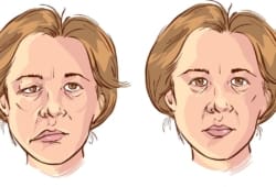 Illustration of a woman with and without Bell’s palsy