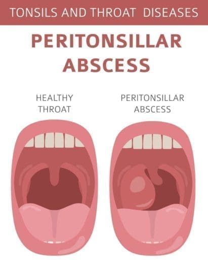 Peritonsillar Abscess