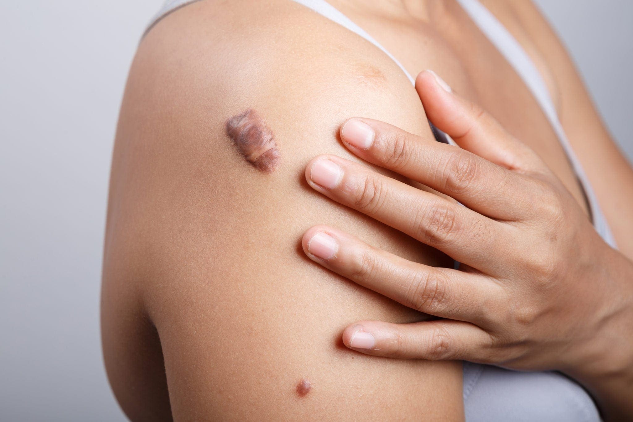How To Get Rid Of Keloids - Treatment 