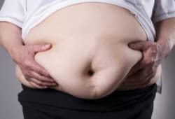 An obese woman’s bare stomach that has a prominent scar
