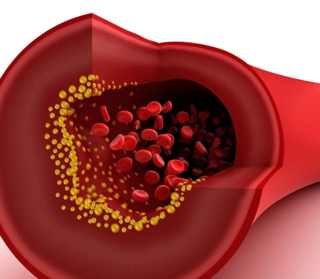 Close-up of a narrowed small blood vessel