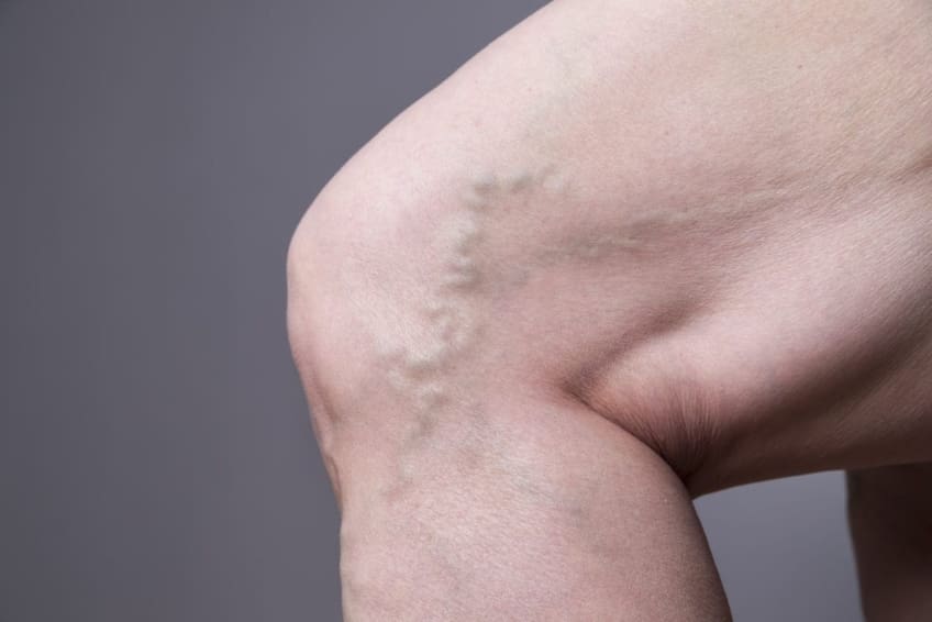 Varicose veins in a 50-year-old male in the left lower limb